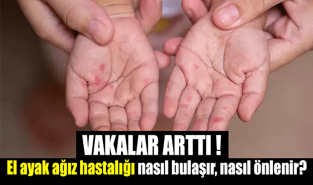 Dikkat! Vakalar arttı, El ayak ağız hastalığı nasıl bulaşır, nasıl önlenir?